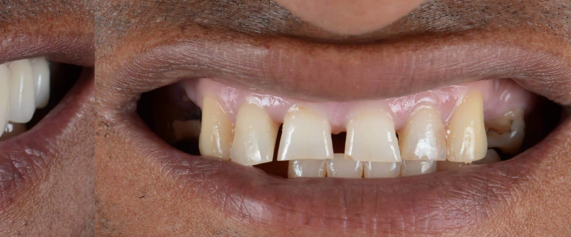 Smile Makeover Techniques That Deliver Natural-Looking Results