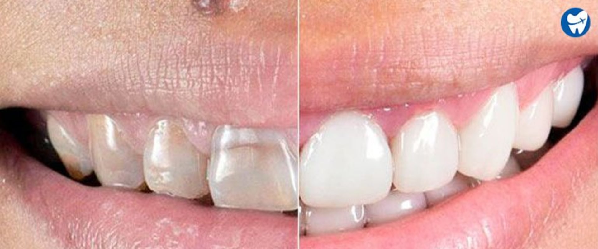 Smile Design Makeover: How Much Does It Cost?
