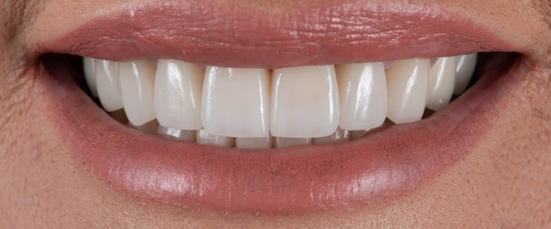 Achieving The Perfect Smile Makeover At A Leading Dental Clinic In Basel