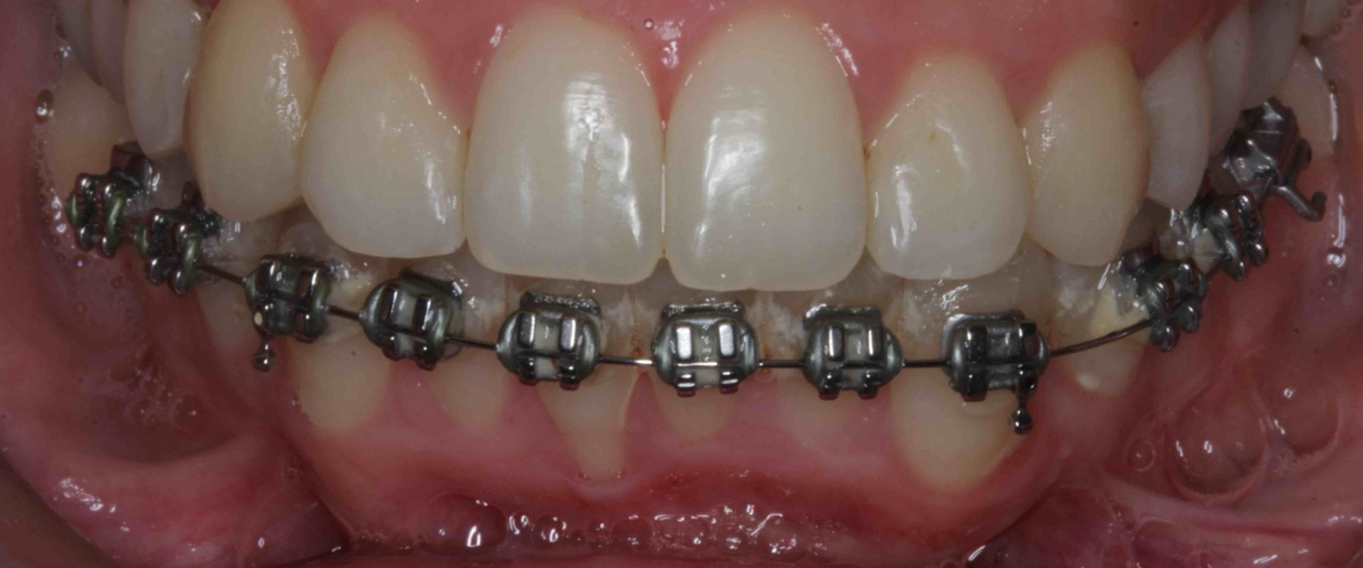 Smile Makeover: Can People with Braces Get a Perfect Smile?