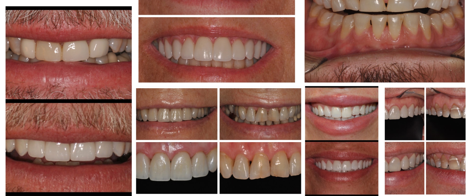 How Long Will the Results of a Smile Makeover Last?