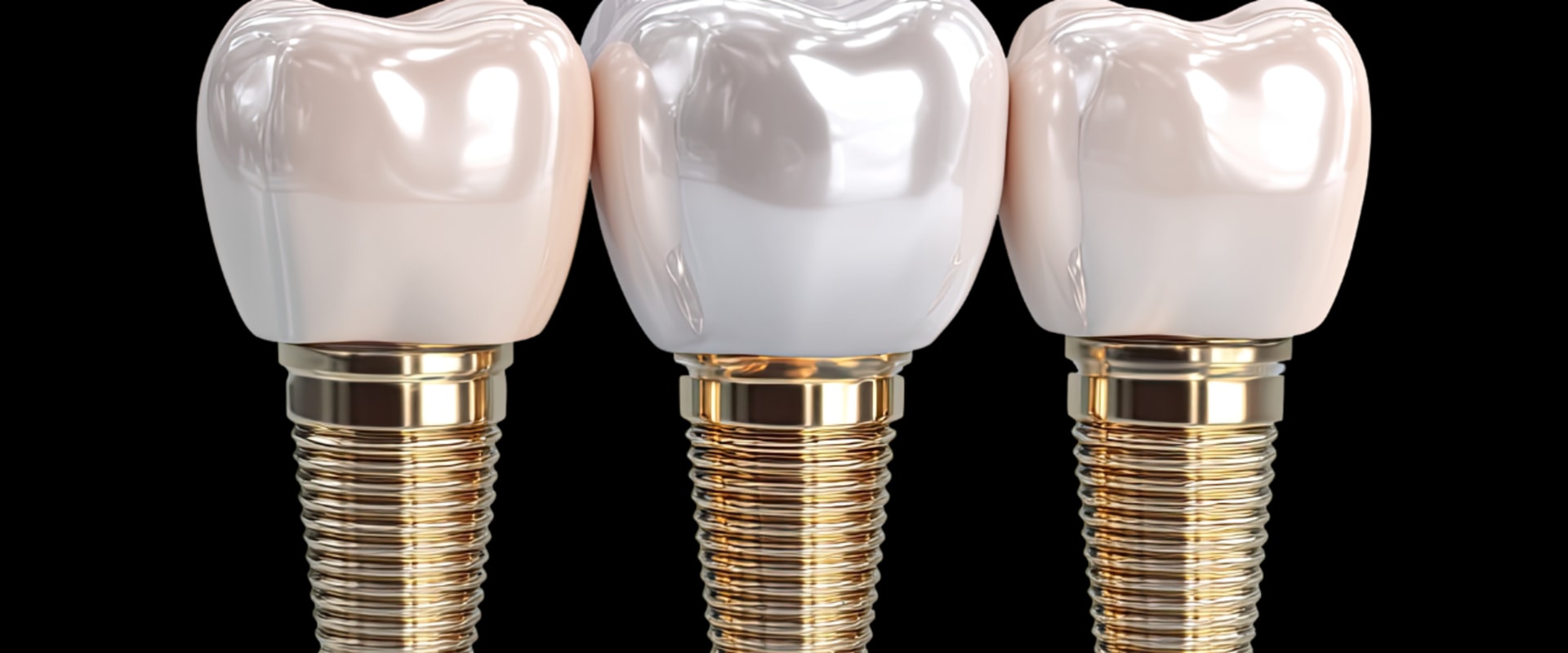 How Dental Implant Surgery in North Little Rock, AR Can Support a Successful Smile Makeover