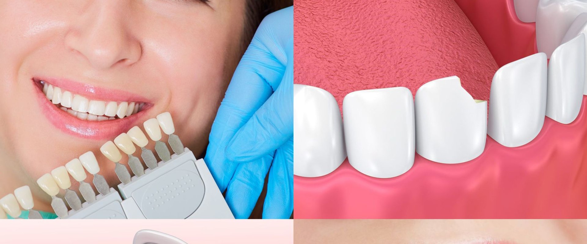 7 Tips for a Smooth Smile Makeover Recovery