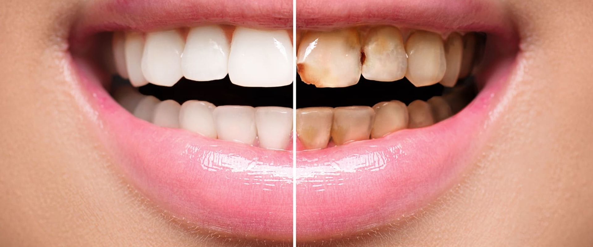 Smile Design: A Comprehensive Guide to Achieving a Perfect Smile