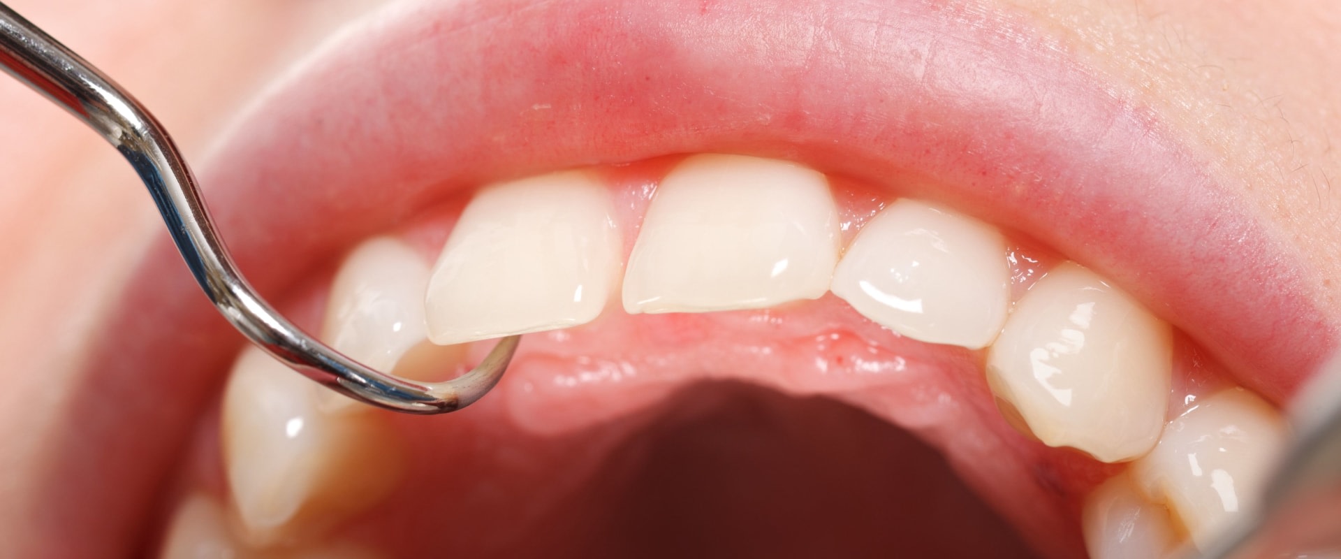 How Often Should You Schedule Dental Cleanings To Maintain Your Smile Makeover In Austin, TX?