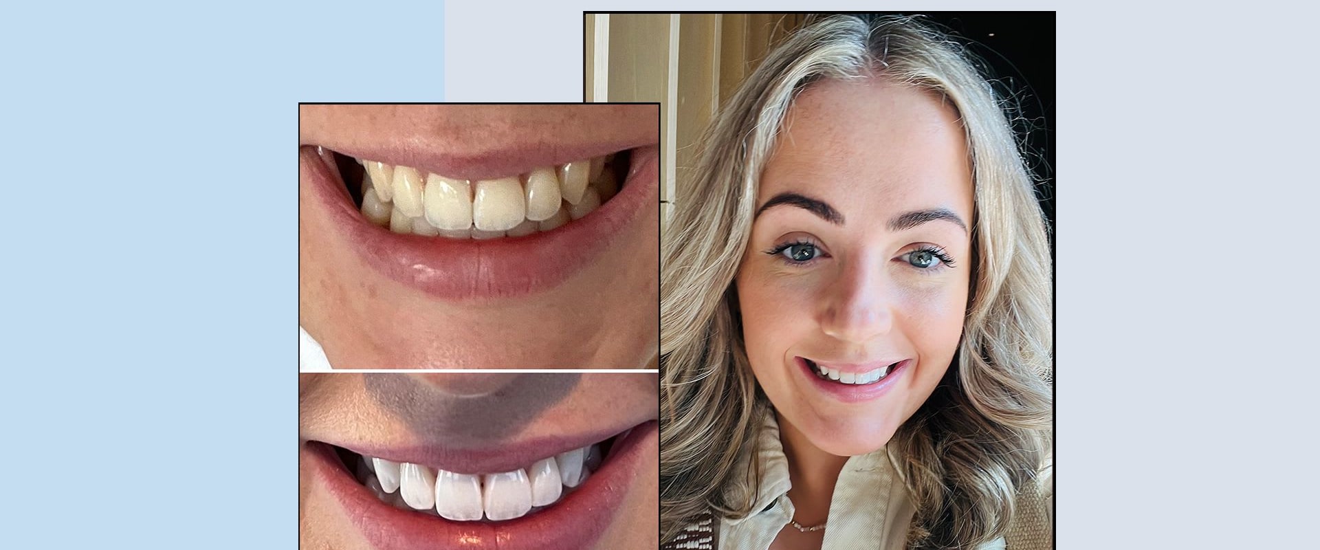 Smile Makeover vs Teeth Whitening: What's the Difference?