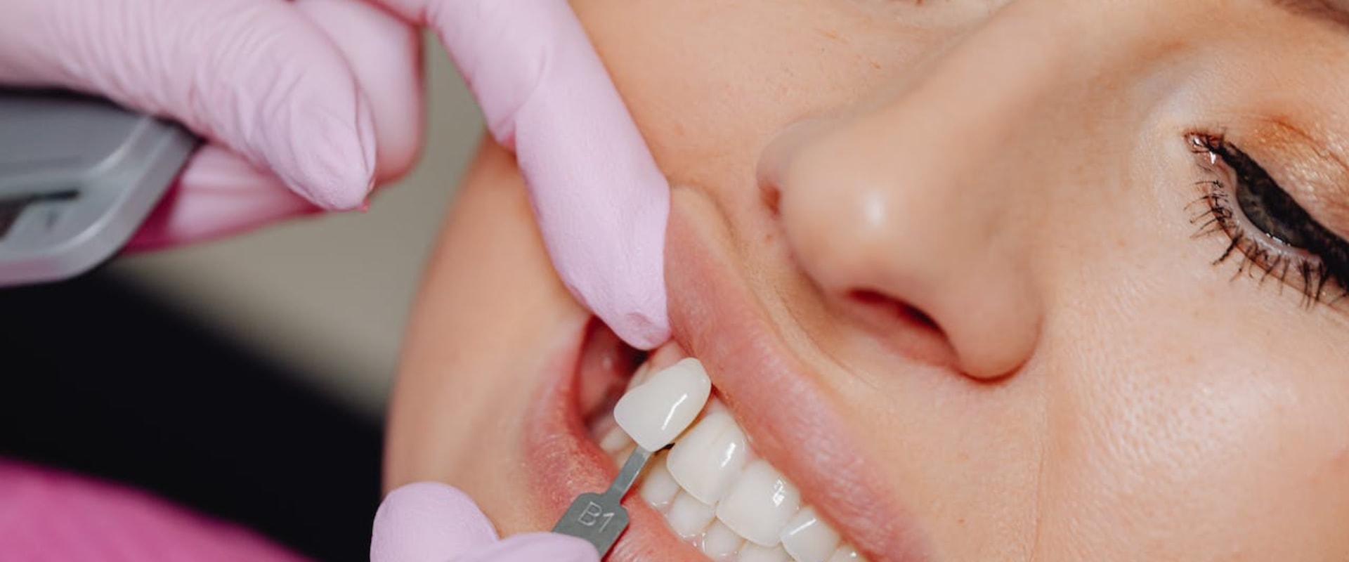 Smile Makeover Secrets: The Power Of Porcelain Veneers In Conroe, TX