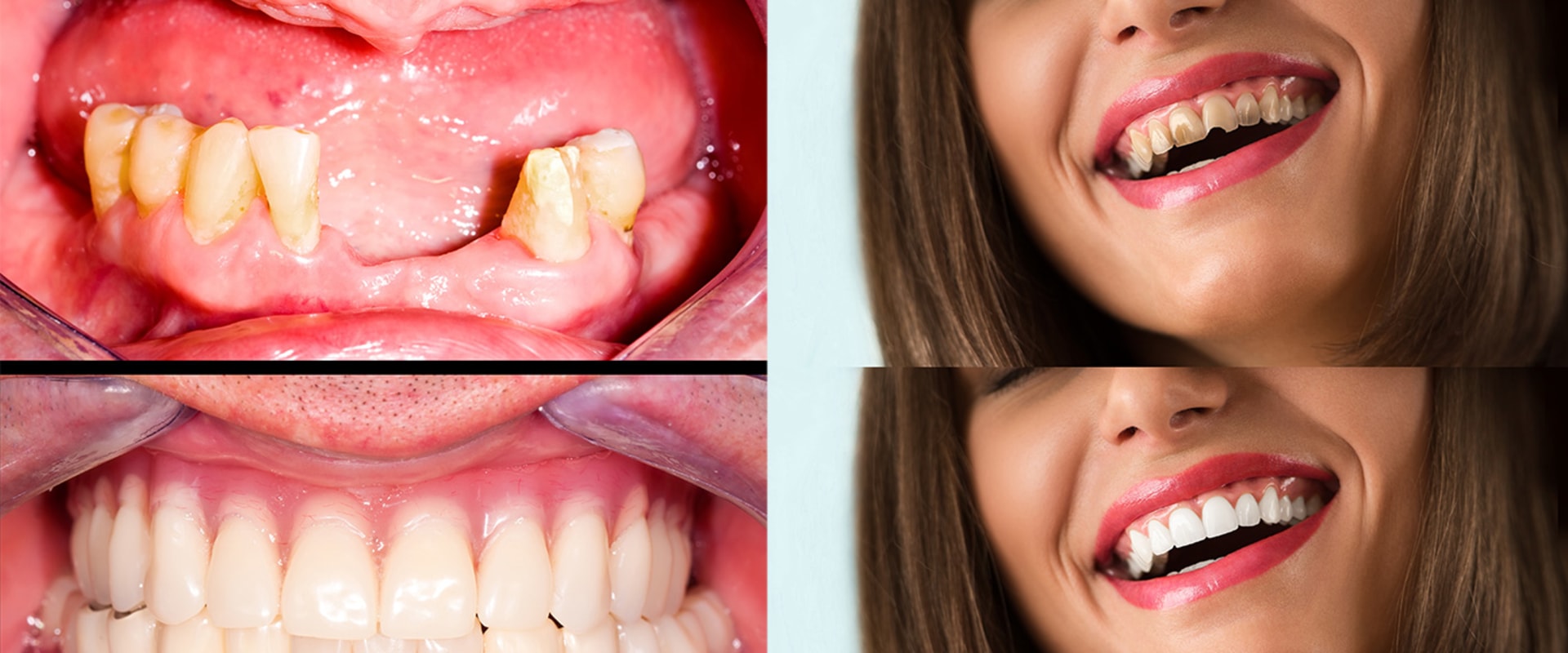 How long is the recovery time after a smile makeover?
