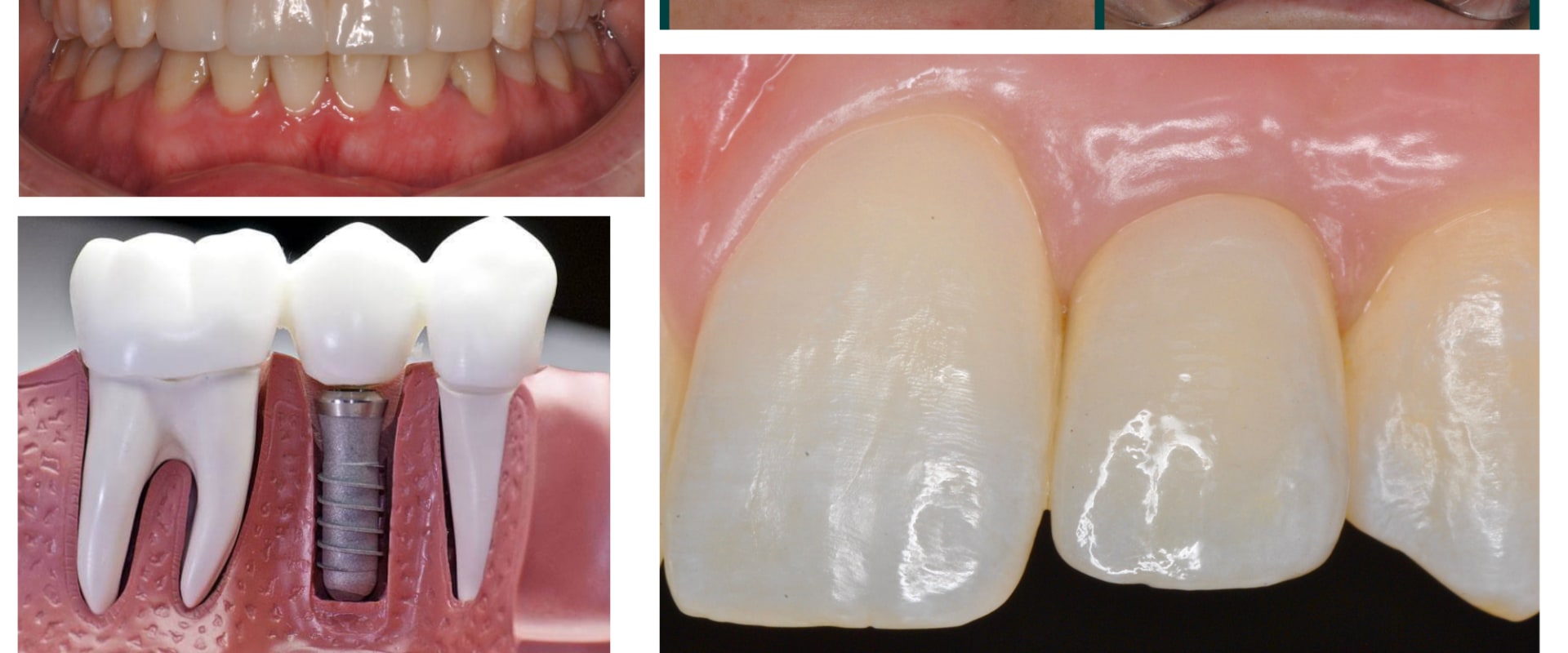 Smile Makeover: A Solution to Missing Teeth