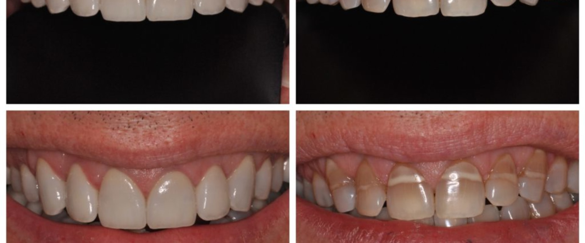 Smile Makeover: The Best Way to Fix Stained or Discolored Teeth