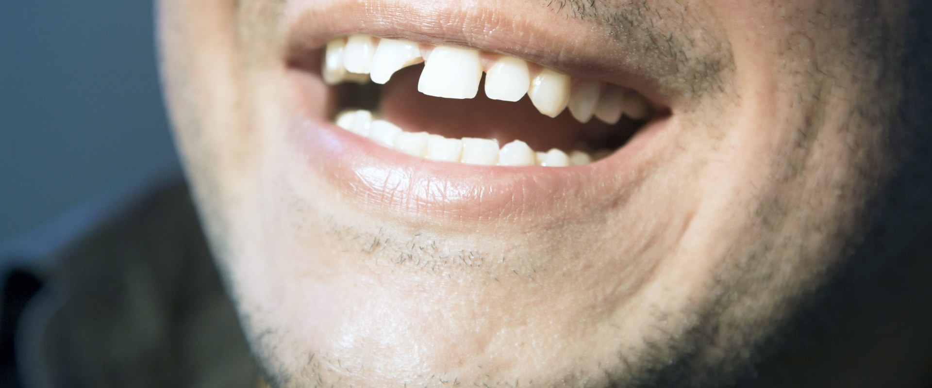 A Smile Makeover: The Perfect Solution for Chipped or Broken Teeth