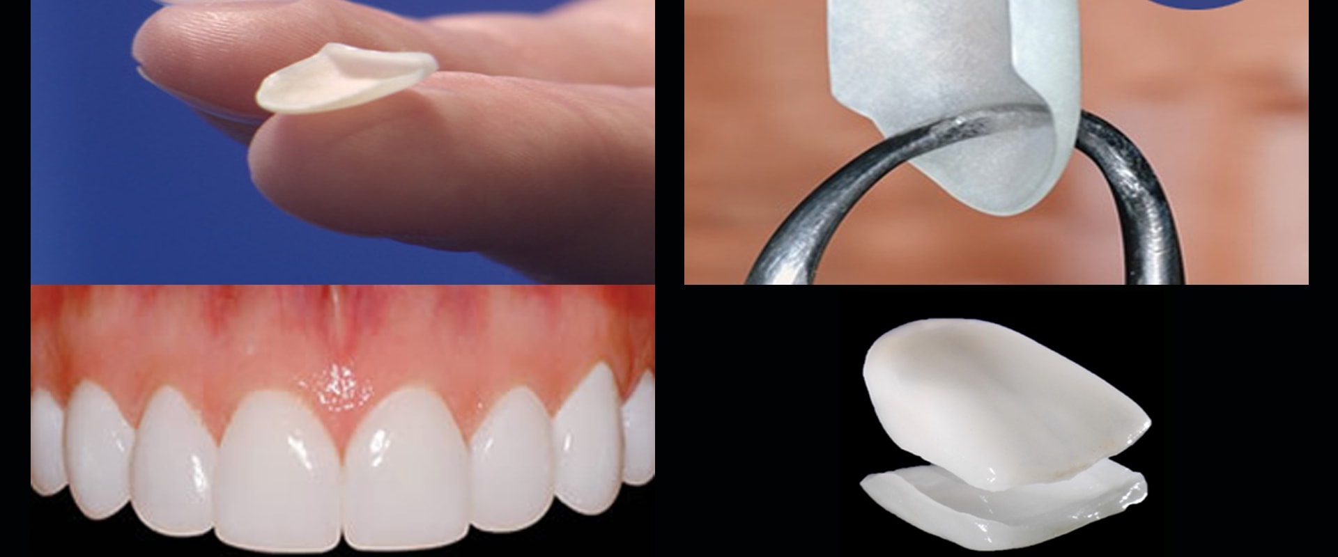 Enhance Your Appearance With Porcelain Veneers: The Ultimate Smile Makeover In Round Rock