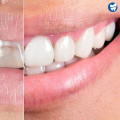 Smile Design Makeover: How Much Does It Cost?