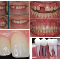 Smile Makeover: Age is Just a Number