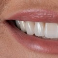 Achieving The Perfect Smile Makeover At A Leading Dental Clinic In Basel