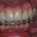 Smile Makeover: Can People with Braces Get a Perfect Smile?