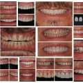 How Long Will the Results of a Smile Makeover Last?