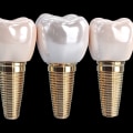 How Dental Implant Surgery in North Little Rock, AR Can Support a Successful Smile Makeover