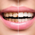 Smile Design: A Comprehensive Guide to Achieving a Perfect Smile