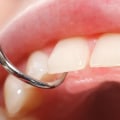 How Often Should You Schedule Dental Cleanings To Maintain Your Smile Makeover In Austin, TX?