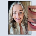 Smile Makeover vs Teeth Whitening: What's the Difference?