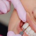 Smile Makeover Secrets: The Power Of Porcelain Veneers In Conroe, TX