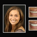 A Comprehensive Guide to Smile Makeovers
