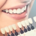 A Comprehensive Guide to Smile Makeovers