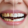 Transform Your Smile: Understanding The Cost Of Braces For A Smile Makeover In Summerville
