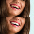 How long is the recovery time after a smile makeover?