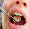 5 Questions to Ask Your Dentist Before Getting a Smile Makeover