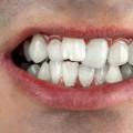 Can a Smile Makeover Fix Crooked Teeth?