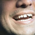 A Smile Makeover: The Perfect Solution for Chipped or Broken Teeth