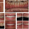 Maintaining Your Smile Makeover: What You Need to Know