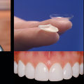 Enhance Your Appearance With Porcelain Veneers: The Ultimate Smile Makeover In Round Rock