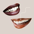 What Age is Best for a Smile Makeover?