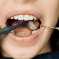 Texas Smiles Transformed: A Deep Dive Into Comprehensive Dentistry For The Ultimate Smile Makeover