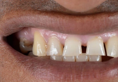 Smile Makeover Techniques That Deliver Natural-Looking Results