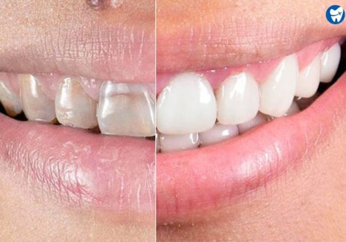 Smile Design Makeover: How Much Does It Cost?