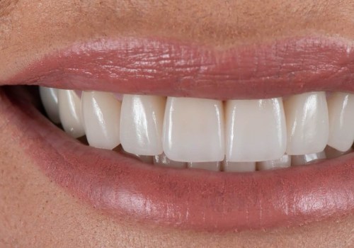 Achieving The Perfect Smile Makeover At A Leading Dental Clinic In Basel