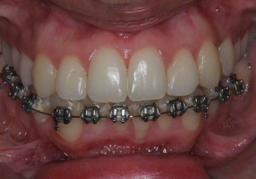 Smile Makeover: Can People with Braces Get a Perfect Smile?