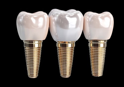How Dental Implant Surgery in North Little Rock, AR Can Support a Successful Smile Makeover