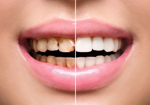 Smile Design: A Comprehensive Guide to Achieving a Perfect Smile
