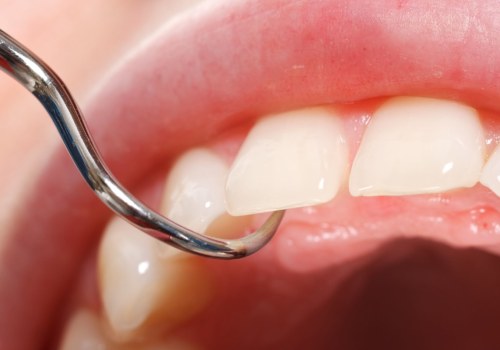 How Often Should You Schedule Dental Cleanings To Maintain Your Smile Makeover In Austin, TX?