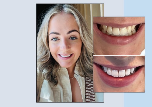 Smile Makeover vs Teeth Whitening: What's the Difference?