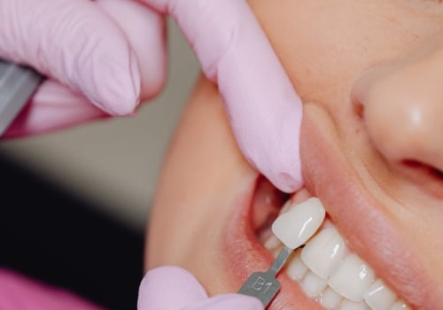 Smile Makeover Secrets: The Power Of Porcelain Veneers In Conroe, TX