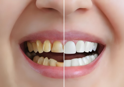 Transform Your Smile: Understanding The Cost Of Braces For A Smile Makeover In Summerville