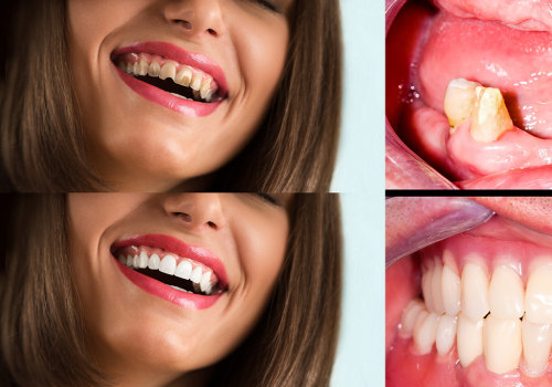 How long is the recovery time after a smile makeover?