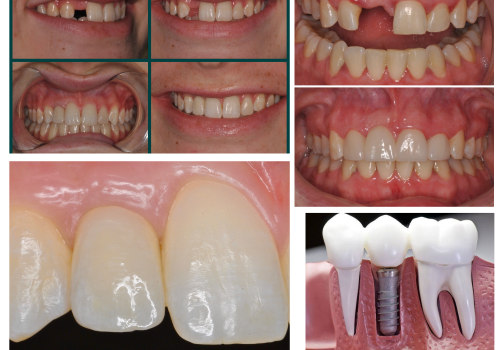 Smile Makeover: A Solution to Missing Teeth