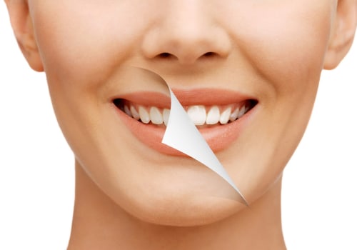 Smile Design vs Smile Makeover: What's the Difference?